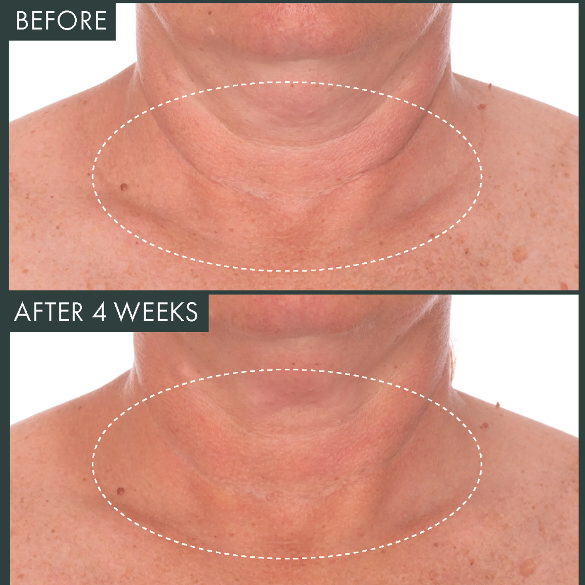 Fermitif Neck Renewal Night Cream / Firming Moisturizer